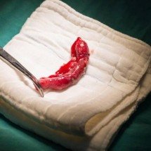 Por que o apêndice inflama com tanta facilidade? Entenda a apendicite, suas causas, sintomas, riscos e como ocorre o tratamento - Portal Giro 10