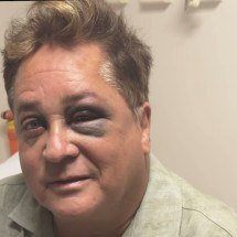 Cantor Leonardo surge com olhos roxos e assusta fãs; entenda - Instagram/ Reprodução