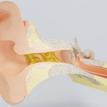 O vilão que protege você: entenda a função da cera de ouvido e por que ela não deve ser removida com cotonete - Portal Giro 10