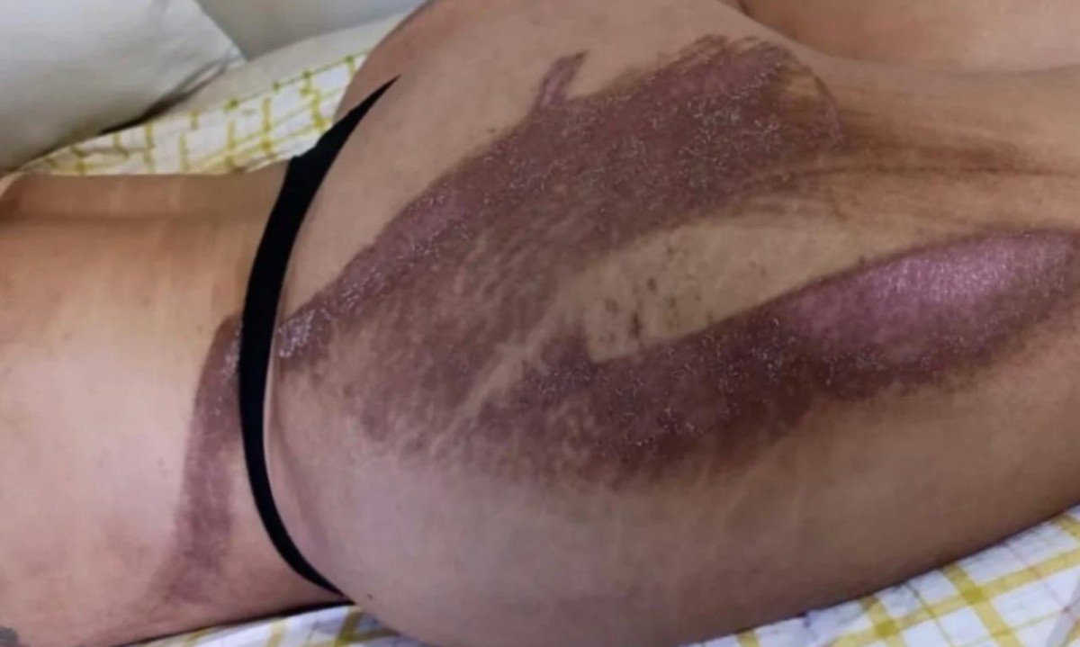 A DJ Danny Albuquerque compartilhou o retorno &agrave; carreira ap&oacute;s um hiato provocado por queimaduras severas