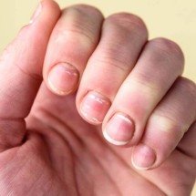 Manchas brancas nas unhas: por que a leuconíquia pontuada quase nunca indica falta de vitaminas ou cálcio - Portal Giro 10