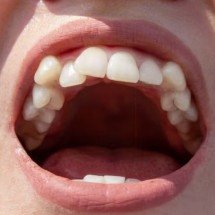 Sorriso desalinhado? Seis problemas que vão além da saúde bucal - Freepik
