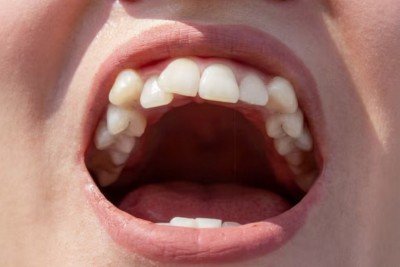 Desalinhamento dentário é progressivo e tende a piorar com o tempo -  (crédito: Freepik)