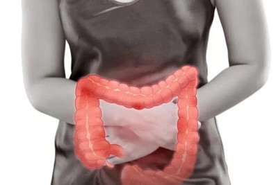 Embora historicamente mais comum em homens, a diverticulite é uma doença que tem mostrado uma mudança de perfil nas últimas décadas -  (crédito: depositphotos.com / Tharakorn)