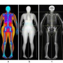 Gordura abdominal está ligada a maior risco de perda urinária em mulheres - Patricia Driusso/UFSCar