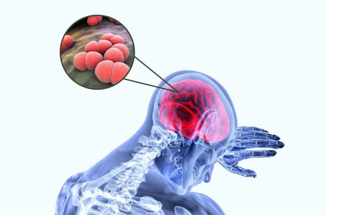 Frequentemente tratada como uma condição única, a meningite é, na verdade, um termo amplo - (crédito: Fhemig/Reprodução)