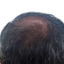 Como a ciência usa células-tronco para estimular folículos dormentes: avanços reais na regeneração capilar e limites atuais clínicos - Portal Giro 10