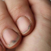 As marcas do tempo nas unhas: como o corpo registra doenças e estresse físico - Portal Giro 10