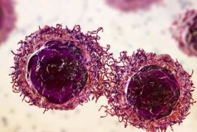 Novo tratamento com pembrolizumabe pode manter pacientes com câncer colorretal livres da doença por anos -  (crédito: Portal Giro 10)
