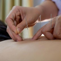 Acupuntura se consolida como prática terapêutica -  TONG0819771233