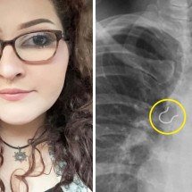Mulher descobre objeto bizarro no pulmão após meses de tosse intensa - People