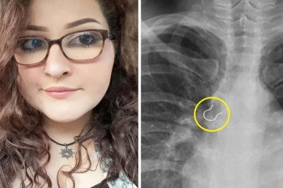 Jovem aspirou piercing sem perceber, sofrendo com fortes tosses por quase um ano -  (crédito: People)
