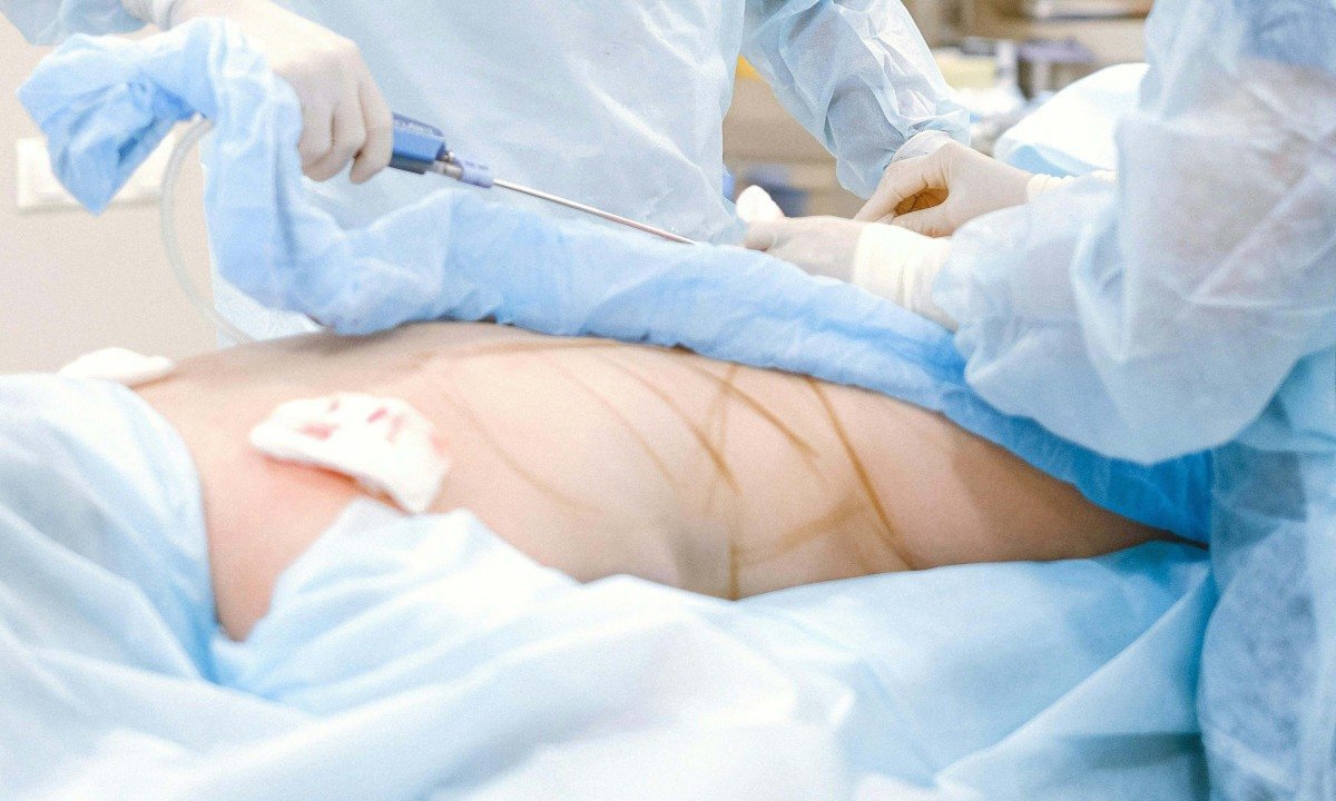 Embolia pulmonar e gordurosa: entenda os riscos fatais de cirurgias plásticas - Pexels