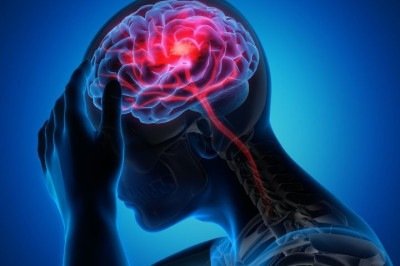 A enxaqueca geralmente causa dor puls&aacute;til e intensa, acompanhada de n&aacute;usea, sensibilidade &agrave; luz, sons e cheiros, al&eacute;m de sintomas neurol&oacute;gicos conhecidos como aura, como flashes luminosos e formigamentos -  (crédito: u_if8o5n0ioo/Pixabay)