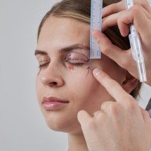 Blefaroplastia exige avaliação pré-cirúrgica individualizada - DINO
