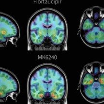 Novo exame de imagem detecta Alzheimer antes dos sintomas surgirem - Laboratório Pascoal, Universidade de Pittsburgh