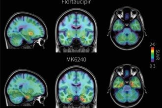 Novo exame de imagem detecta Alzheimer antes dos sintomas surgirem