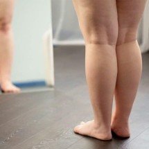 Confusão com obesidade liga alerta sobre lipedema - Magnific