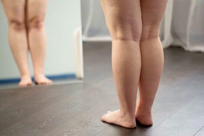 O lipedema é geralmente identificado pelo aspecto visual -  (crédito: Magnific)