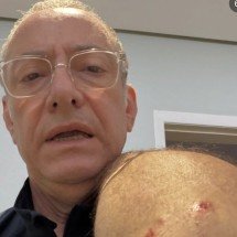 Jornalista da Globo é atacado por pitbull e alerta tutores -  Reprodução/ Redes Sociais