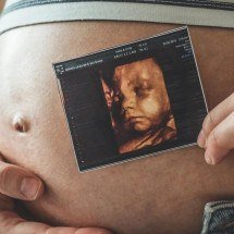 Ultrassonografia obstétrica avança no diagnóstico pré-natal - DINO