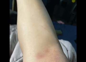 V&iacute;tima ficou com hematomas ap&oacute;s a viol&ecirc;ncia sexual, constatados por exame de corpo de delito -  (crédito: Reprodu&ccedil;&atilde;o)