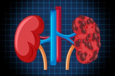 Características como tamanho, localização e potencial de agressividade do tumor ajudam a definir a melhor conduta       -  (crédito: brgfx/Magnific)