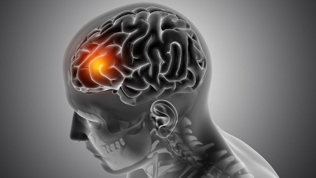 A inflama&ccedil;&atilde;o das meninges, membranas que revestem o c&eacute;rebro, &eacute; a caracter&iacute;stica central da meningite. -  (crédito: magnific)