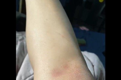 Vítima ficou com hematomas após a violência sexual, constatados por exame de corpo de delito -  (crédito: Reprodução)
