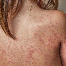 Avanço do sarampo na América do Norte é alerta para brasileiros no Mundial  - Magnific