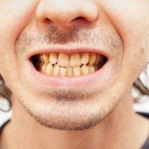 Dentes amarelados? Hábitos que contribuem para o escurecimento do sorriso - Magnific
