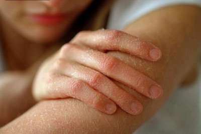 Psoríase é uma doença inflamatória de natureza autoimune. Não é transmissível por qualquer tipo de contato físico, toque ou compartilhamento de objetos -  (crédito: Magnific)