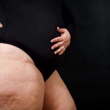 Lipedema: por que os hematomas surgem com frequência nas pernas? - Magnific