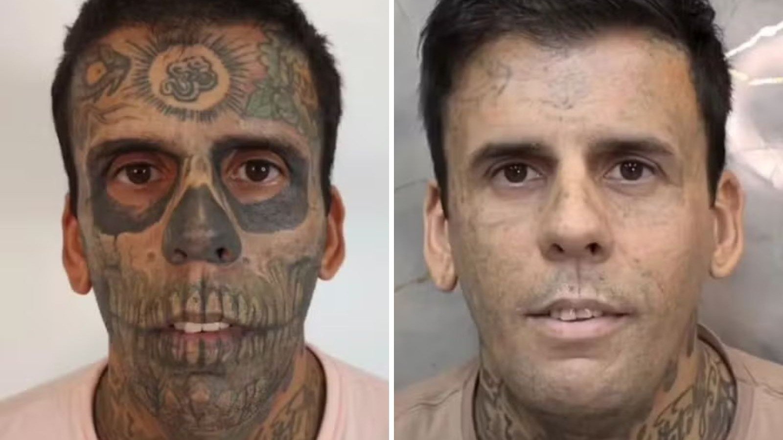 Leandro de Souza mostra a progress&atilde;o da remo&ccedil;&atilde;o das tatuagens no rosto, processo interrompido pela descoberta de um tumor na bexiga -  (crédito: Redes sociais)
