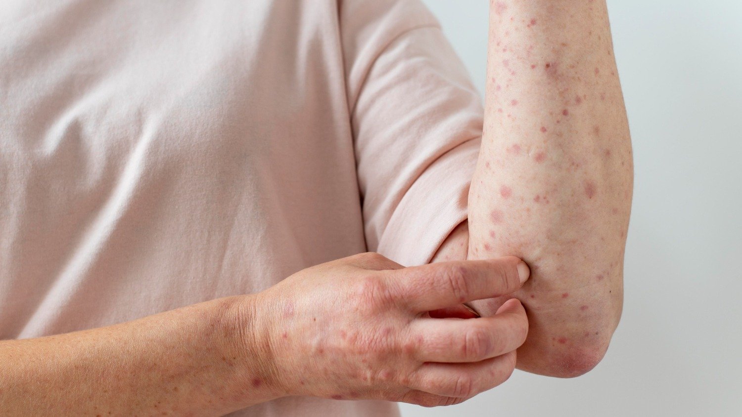 Les&otilde;es cut&acirc;neas causadas pela mpox surgem na pele e evoluem por diferentes est&aacute;gios, exigindo aten&ccedil;&atilde;o m&eacute;dica -  (crédito: Freepik)