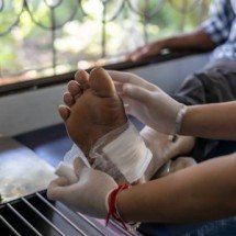 Nanopartícula desenvolvida na USP acelera cicatrização de feridas crônicas - Shutterstock/Fapesp/Reprodução
