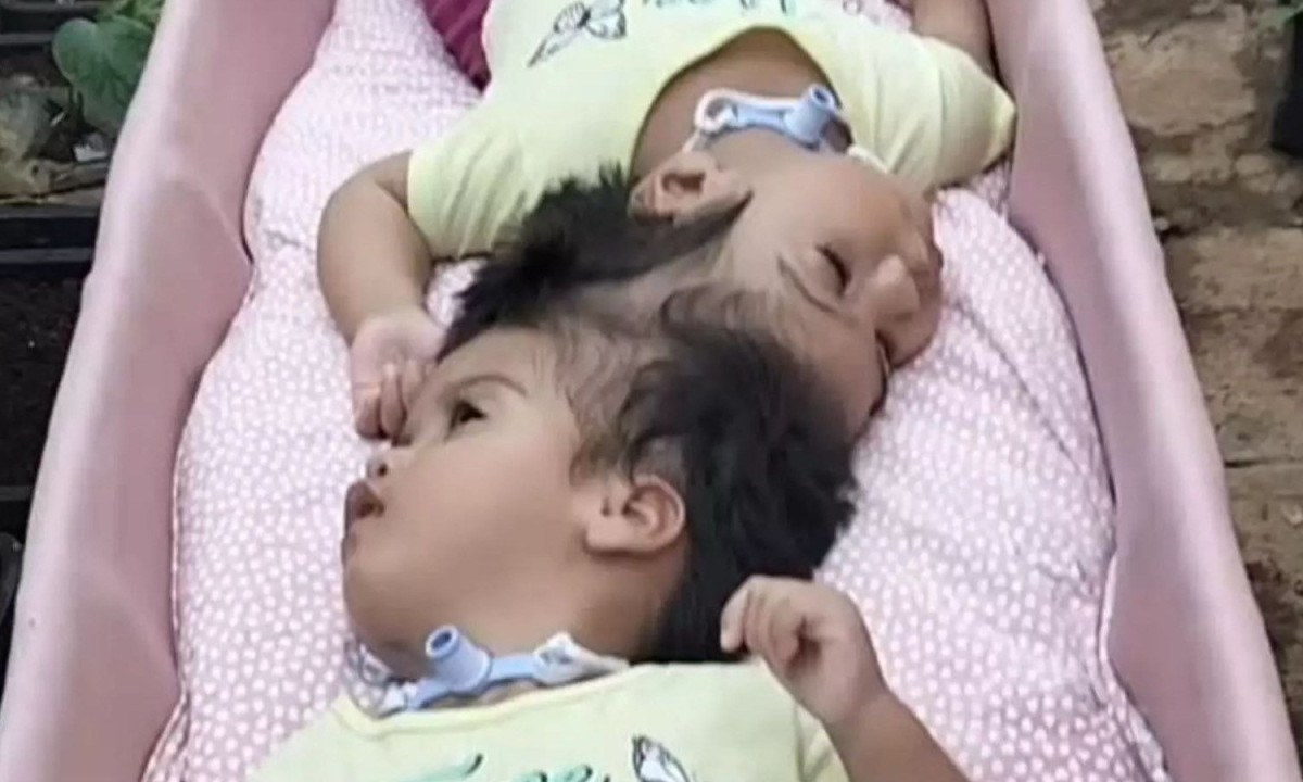 Heloísa e Helena, as gêmeas unidas pela cabeça que morreram durante a cirurgia de separação - (crédito: Redes sociais)