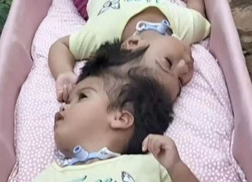 Helo&iacute;sa e Helena, as g&ecirc;meas unidas pela cabe&ccedil;a que morreram durante a cirurgia de separa&ccedil;&atilde;o -  (crédito: Redes sociais)