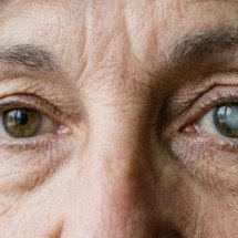 Cirurgia precoce devolve a nitidez a pacientes com catarata - IA/Gemini