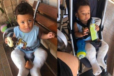 Ravi Luiz Vitorino Gonzaga foi diagnosticado com pé torto congênito poucas horas depois de nascer -  (crédito: Raquel Vitorino)