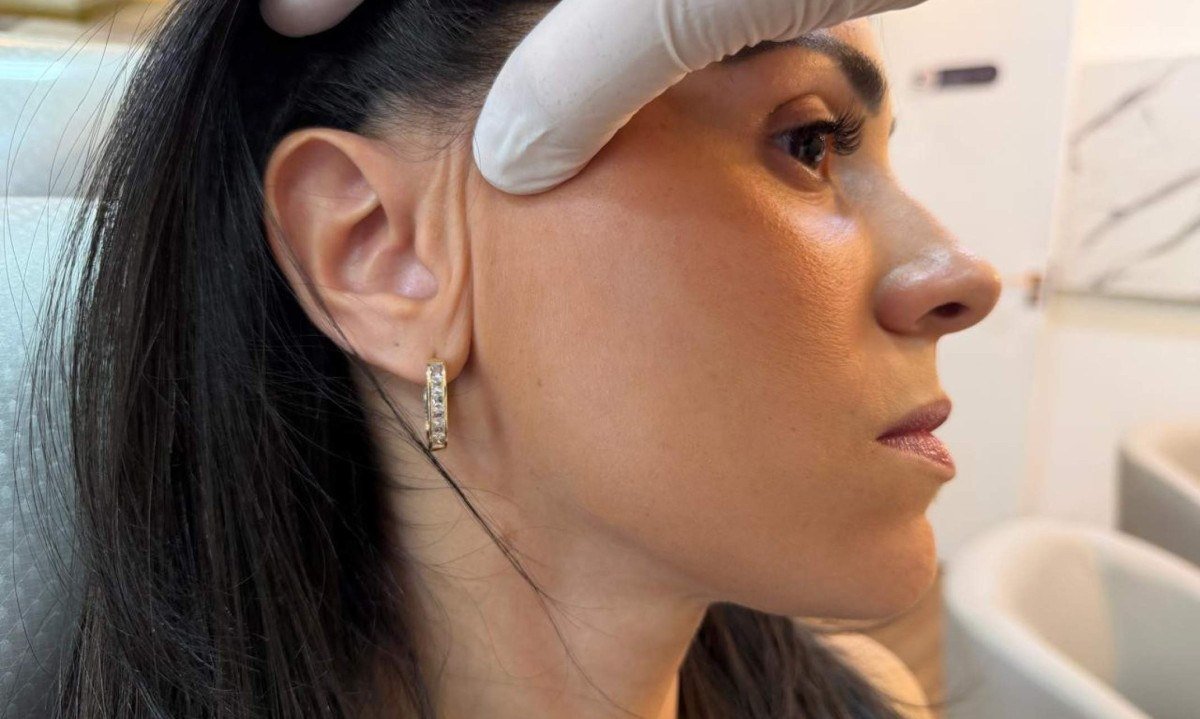 Lifting facial endoscópico dispensa cicatriz visível - (crédito: DINO)