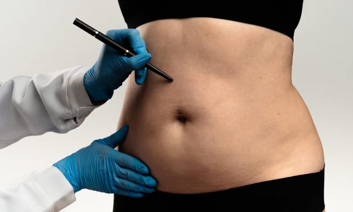 Lipoaspiração lidera preferência por cirurgias plásticas - (crédito: DINO)