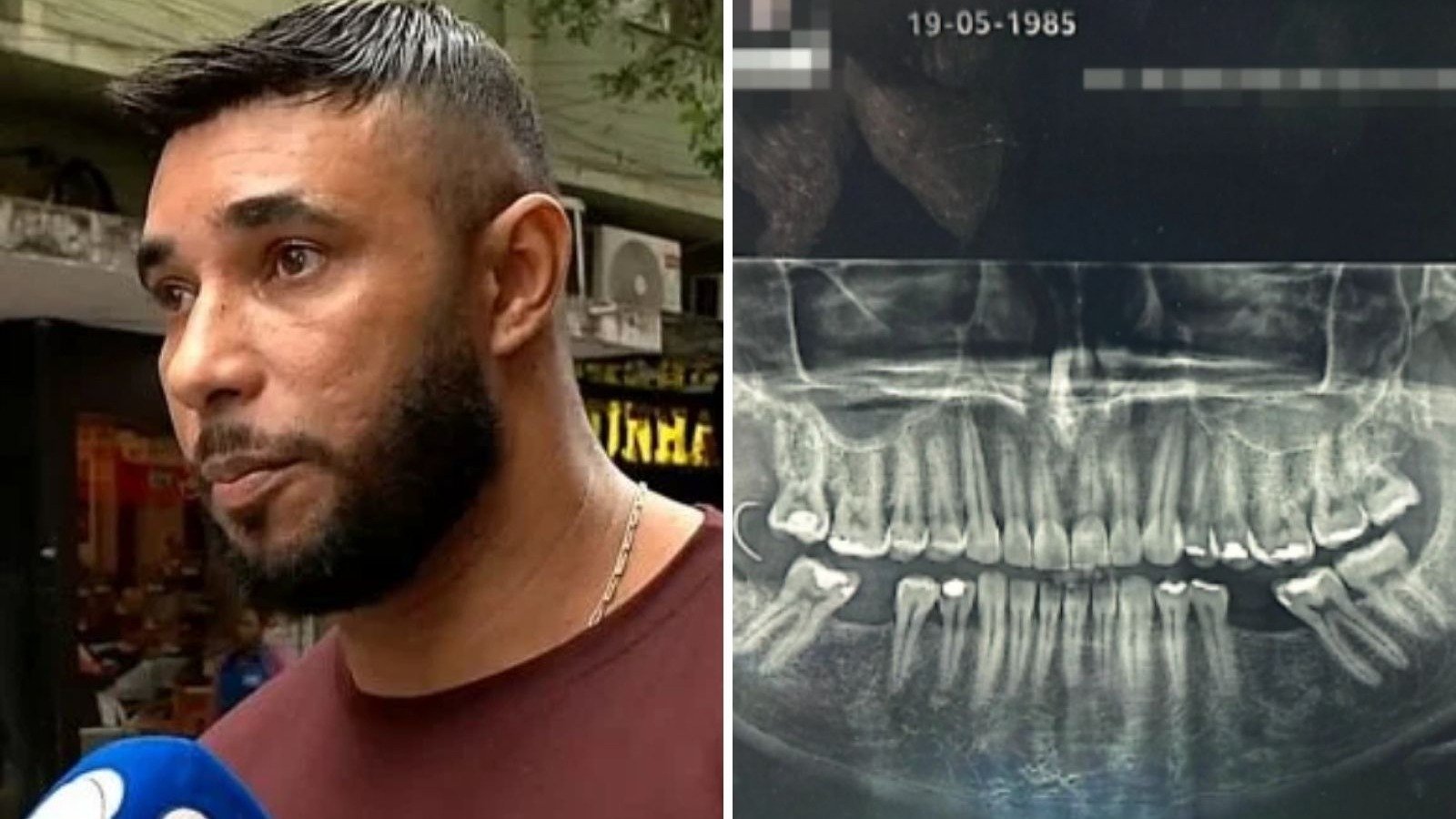 Ap&oacute;s extrair um dente siso, Diego Augusto Ribeiro, de 39 anos, descobriu por meio de uma radiografia que uma agulha ficou alojada em sua gengiva. -  (crédito: TV Record)