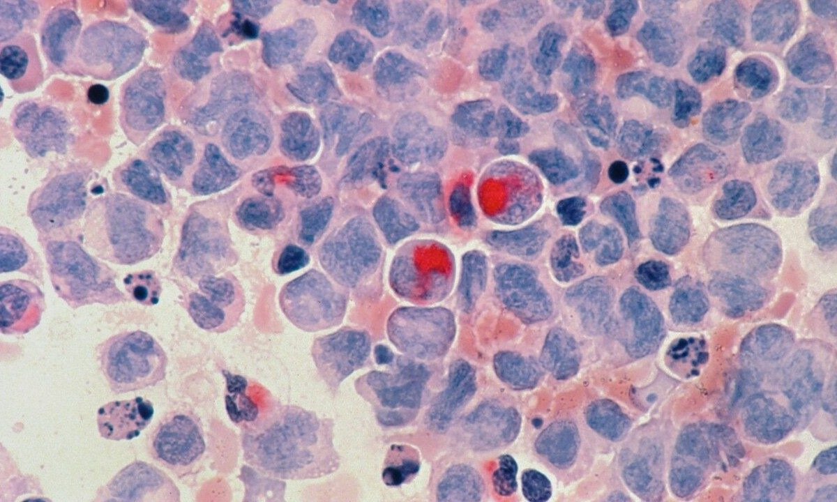 Resultados preliminares, apresentados na FAPESP Week França em junho de 2025, mostraram que a molécula BamazScplp1 teve, em testes com células de câncer de mama, ação comparável à do paclitaxel, quimioterápico usado no tratamento da doença. A descoberta, porém, ainda está em fase experimental e não representa um novo medicamento disponível para pacientes. -  (crédito: Unsplash / National Cancer Institute)