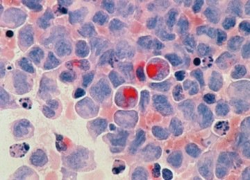 Resultados preliminares, apresentados na FAPESP Week França em junho de 2025, mostraram que a molécula BamazScplp1 teve, em testes com células de câncer de mama, ação comparável à do paclitaxel, quimioterápico usado no tratamento da doença. A descoberta, porém, ainda está em fase experimental e não representa um novo medicamento disponível para pacientes. -  (crédito: Unsplash / National Cancer Institute)