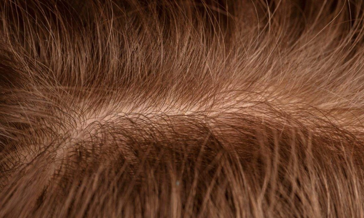 O couro cabeludo possui glândulas sebáceas, folículos, vasos sanguíneos e uma microbiota própria, além de funcionar como uma barreira de proteção - (crédito: Reprodução/Magnific)