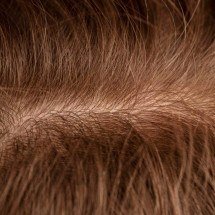 Queda de cabelo nem sempre é calvície: diagnóstico muda o tratamento - Reprodu&ccedil;&atilde;o/Magnific