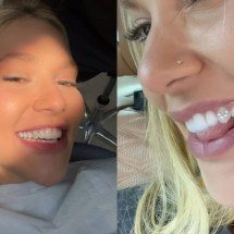 Diamante no dente como o de Virginia pode favorecer acúmulo de placa se higiene for inadequada - Reprodução/Instagram