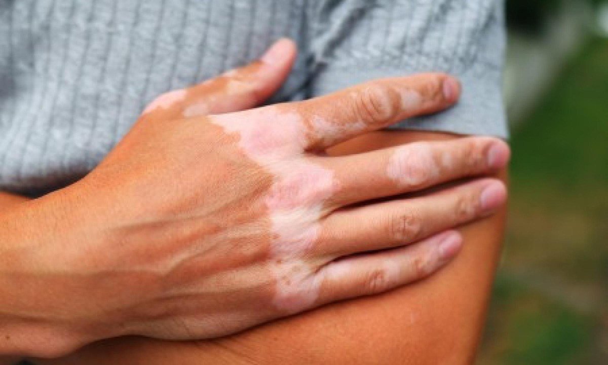 Em portadores da doença, o próprio sistema imune ataca as células produtoras de melanina, o que causa o surgimento de manchas brancas na pele - (crédito: Shutterstock))