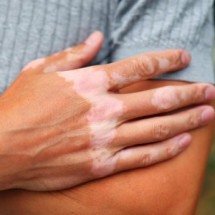 Genes virais incorporados ao genoma humano podem indicar piora do vitiligo